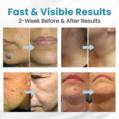 💎 LOVILDS™ Laser Pen – Safe, Painless & Effective Mole & Wart Removal