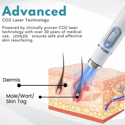 💎 LOVILDS™ Laser Pen – Safe, Painless & Effective Mole & Wart Removal