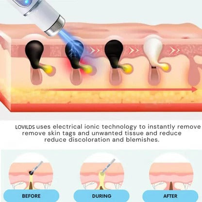 💎 LOVILDS™ Laser Pen – Safe, Painless & Effective Mole & Wart Removal