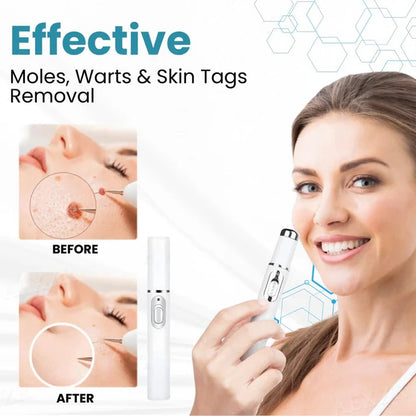 💎 LOVILDS™ Laser Pen – Safe, Painless & Effective Mole & Wart Removal